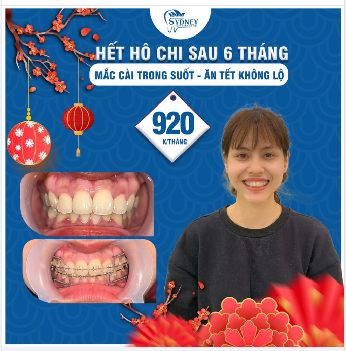 Niềng răng hô đón Tết chỉ 920k/tháng