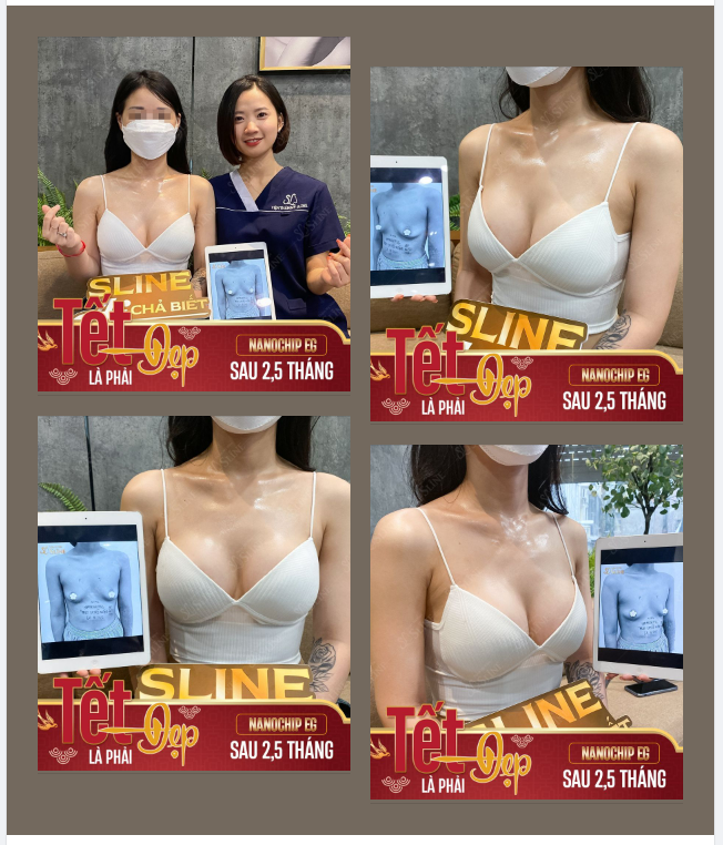 Feedback Nâng ngực  sau 2,5 tháng
