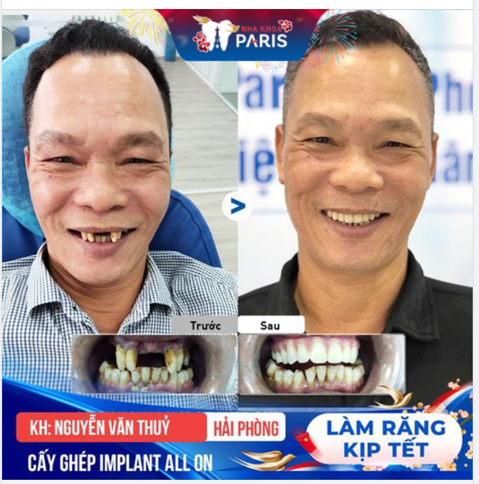 NHƯ TÌM THẤY CUỘC ĐỜI MỚI VỚI CẤY GHÉP  IMPLANT ALL ON 4