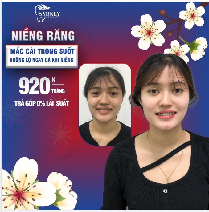 Thoải mái niềng răng, cười tươi rạng rỡ đón Tết 2023