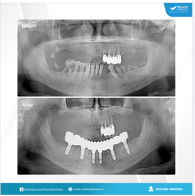 TRỒNG RĂNG IMPLANT TỪ SỚM GIÚP MANG LẠI NHIỀU LỢI ÍCH CHO KHÁCH HÀNG