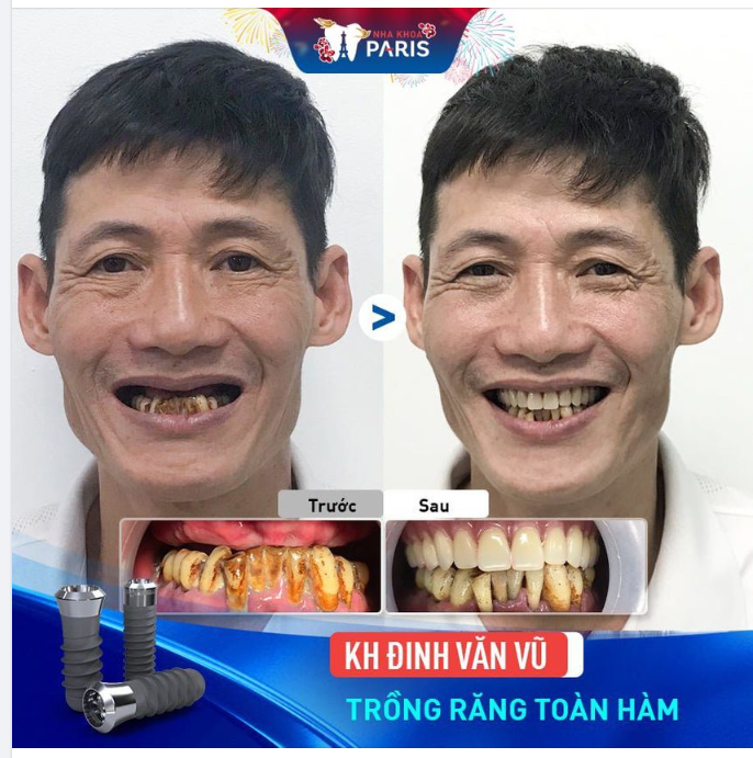TRẺ HƠN 10 TUỔI SAU CẤY IMPLANT TOÀN HÀM
