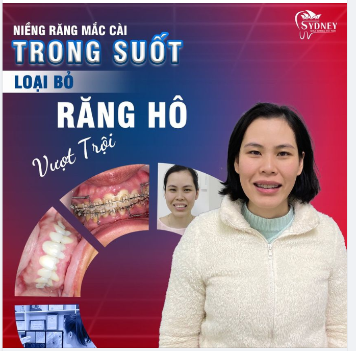 Niềng răng đổi vận – Công việc như ý