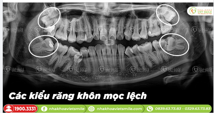 CÁC KIỂU RĂNG KHÔN MỌC LỆCH THƯỜNG GẶP