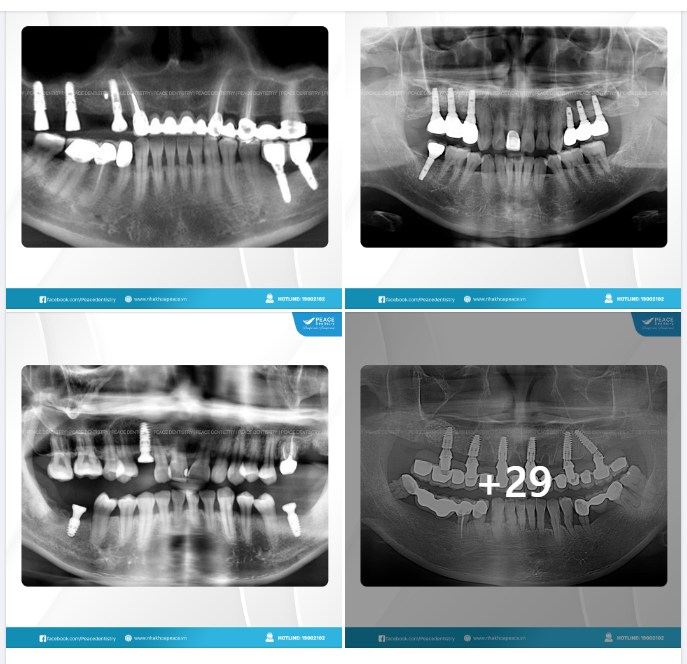 Implant Gallery - Peace Dentistry