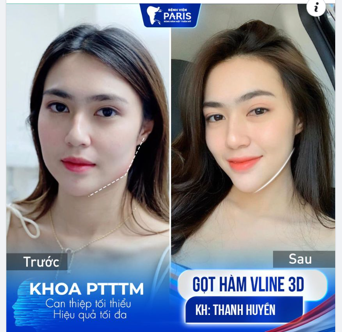 Nhan sắc - thần thái thăng hạng sau Gọt hàm Vline 3D