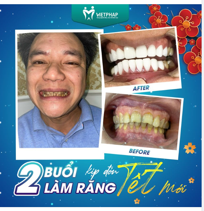 2 BUỔI LÀM RĂNG – KỊP ĐÓN TẾT MỚI