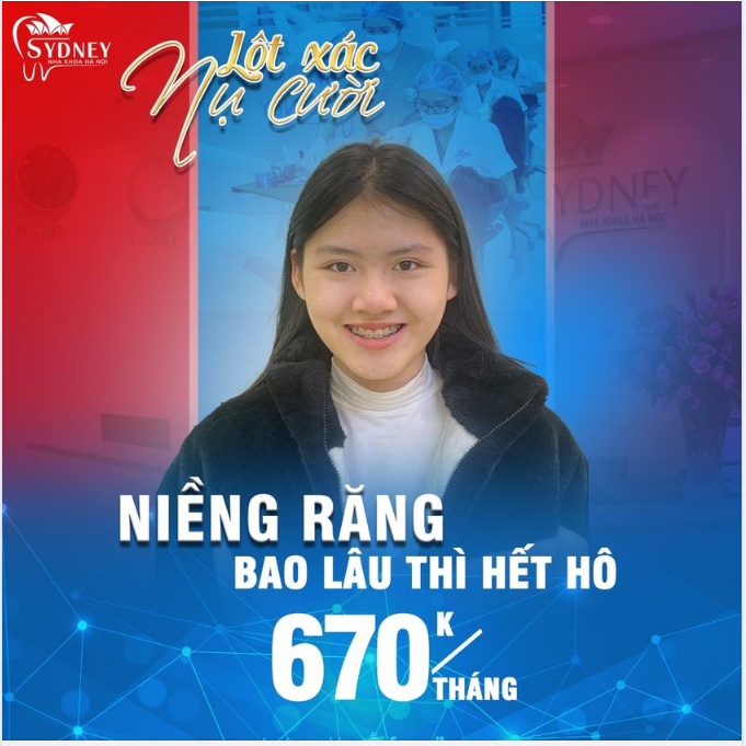 Thời gian niềng răng hô mất bao lâu?