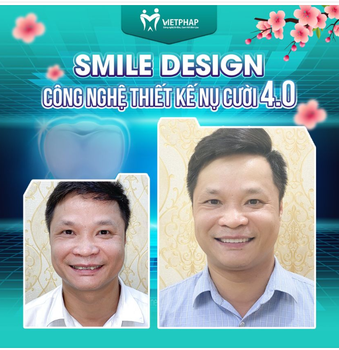 ĐẸP KỊP TẾT NHỜ CÔNG NGHỆ SMILE DESIGN 4.0