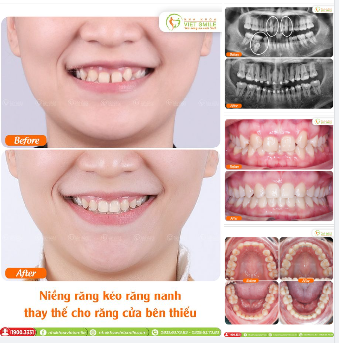 NIỀNG RĂNG KÉO RĂNG NANH THAY THẾ CHO RĂNG CỬA BÊN THIẾU