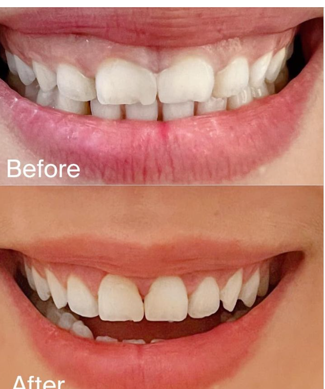 Chia sẻ từ chị khách hàng dễ thương, vừa hoàn thành được 1/2 chặng đường hướng đến 1 nụ cười đẹp, tự tin và thu hút hơn, hạnh phúc hơn.