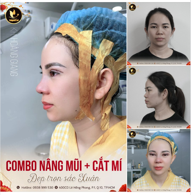 COMBO NÂNG MŨI + CẮT MÍ ĐẸP TRỌN SẮC XUÂN
