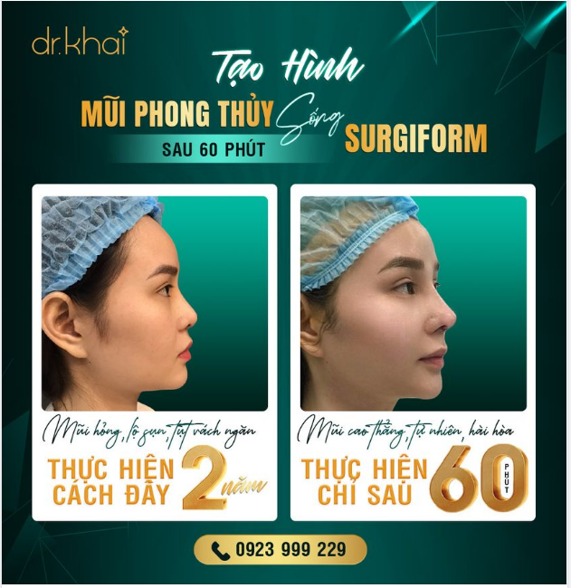 60 PHÚT SỞ HỮU DÁNG MŨI PHONG THUỶ CÙNG SỐNG SURGIFORM