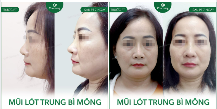 Nhiều người trong chúng ta có lẽ vẫn còn xa lạ với phương pháp nâng mũi lót trung bì mông.