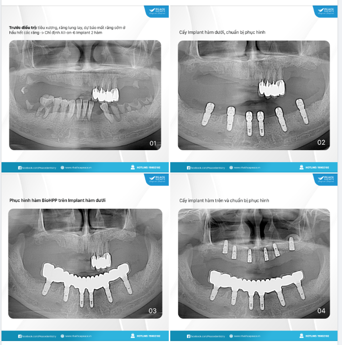 Ca lâm sàng All-on-6 Implant hai hàm để khách hàng đón Tết thật trọn vẹn!