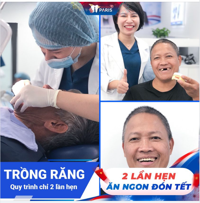 QUY TRÌNH TRỒNG RĂNG CHỈ 2 LẦN HẸN