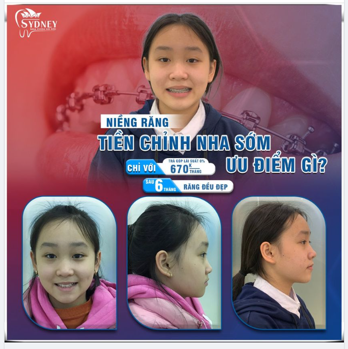 Những lợi ích của tiền chỉnh nha mang lại