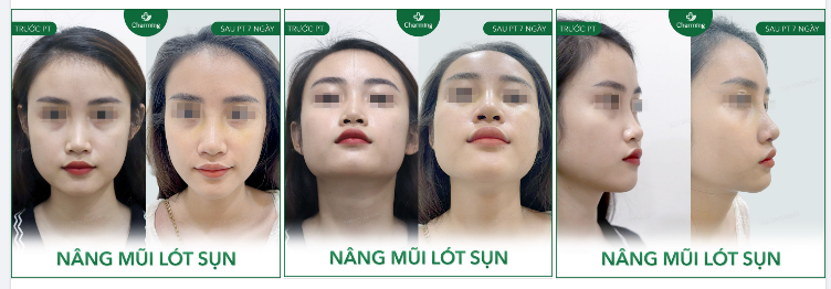 Mũi nằm ở vị trí trung tâm nên có tầm ảnh hưởng khá quan trọng đối với sự cân đối của toàn gương mặt.