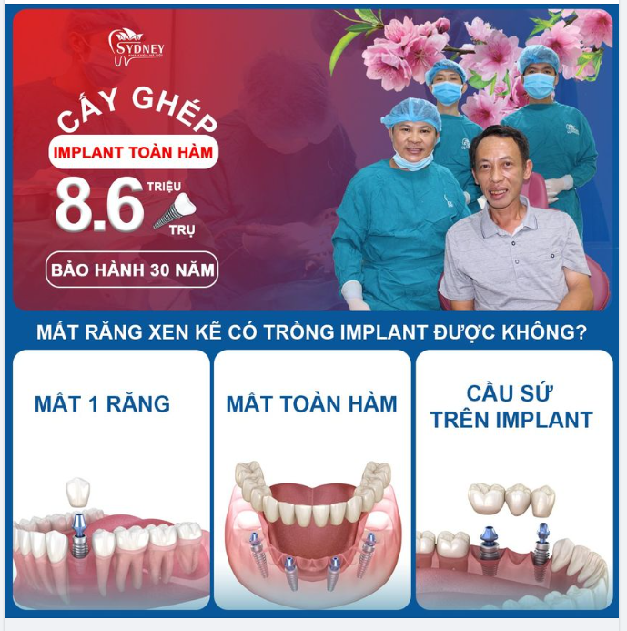 Mất răng xen kẽ có trồng Implant được không?