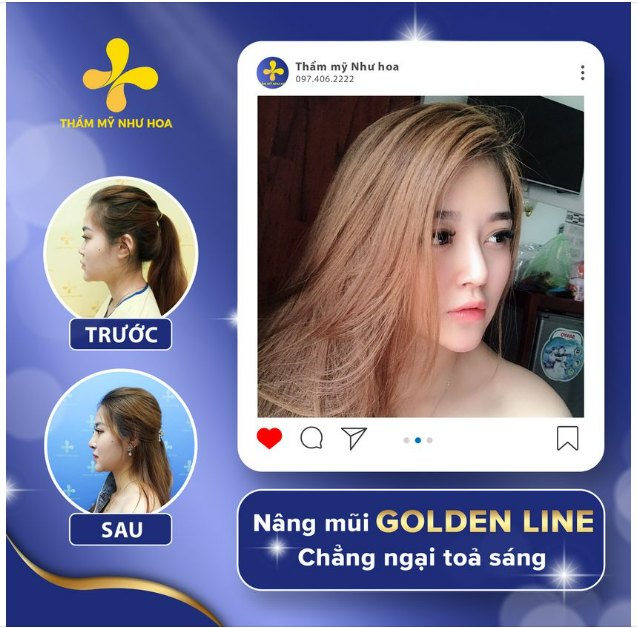 MŨI XINH - NHAN SẮC THÊM LUNG LINH chỉ sau HƠN 1 TUẦN! Thẩm mỹ Như Hoa cảm ơn sự tin tưởng và ủng hộ của chị Hồng Nhung!