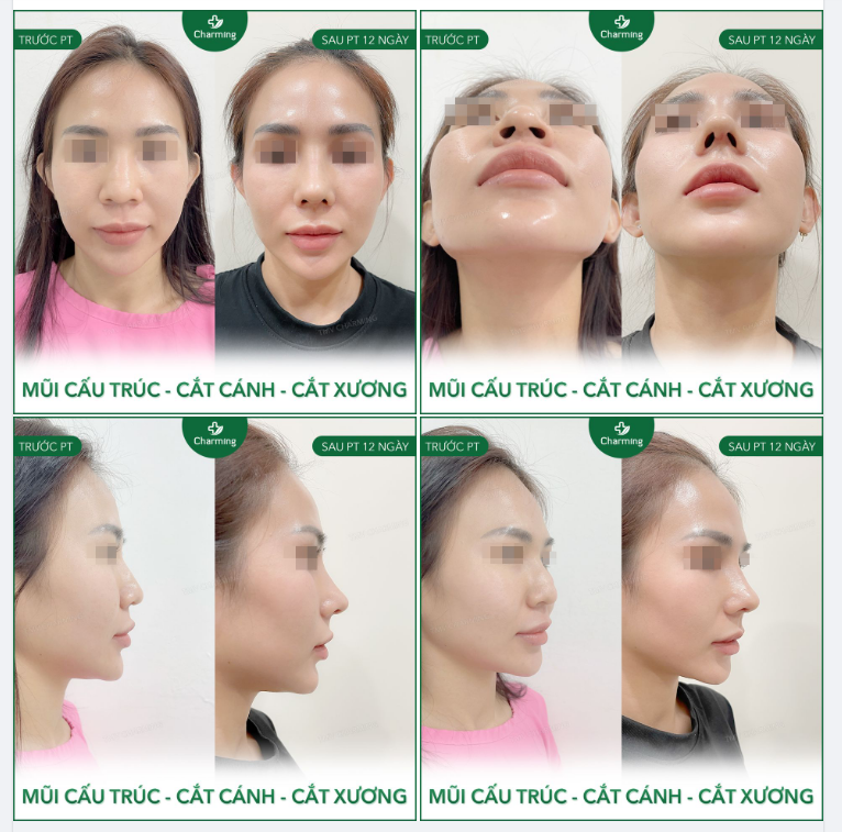 Khách thích mũi cao, bay, nhưng mũi làm trước đó bị lệch sóng, dáng thô. Nếu muốn cao tây, dáng đẹp thì chỉ có thể sửa lại bằng phương pháp cấu trúc mà thôi.
