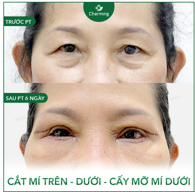 Ước chi đôi mắt của chúng ta có chế độ tự cân bằng lượng mỡ ở cả mí trên và mí dưới nhỉ.