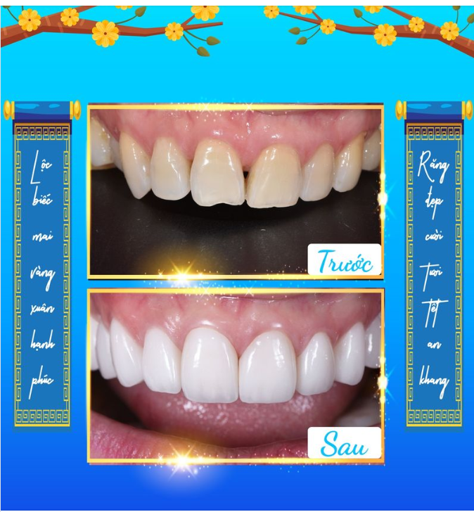 Lộc biếc mai vàng xuân hạnh phúc - Răng đẹp cười tươi tết an khang