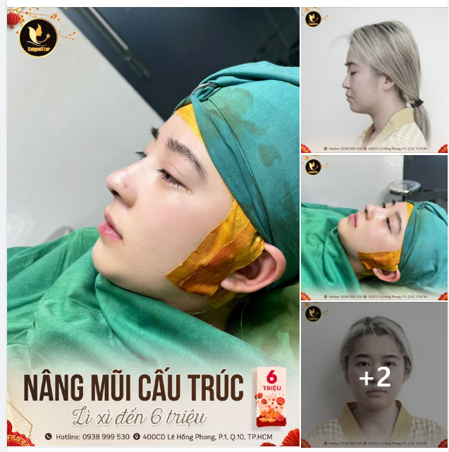 NÂNG MŨI CẤU TRÚC LÌ XÌ ĐẾN 6TR