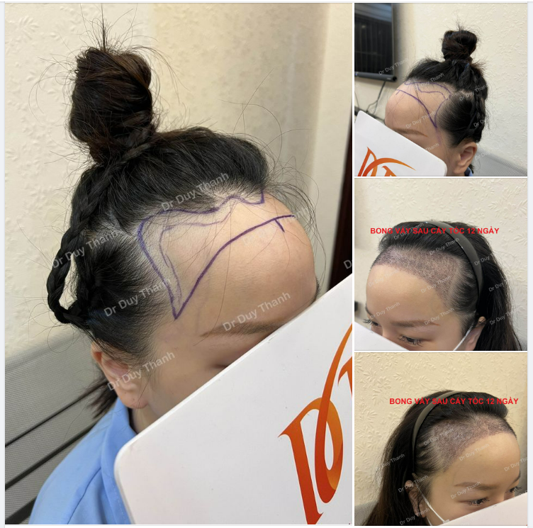 12 NGÀY SAU CẤY TÓC- BONG VẢY