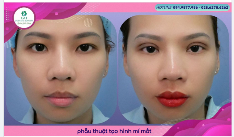 GIẢI PHÁP CHO ĐÔI MÍ LÓT KHÔNG ĐỀU ĐẸP NGAY CHỈ MỚI 30 PHÚT 