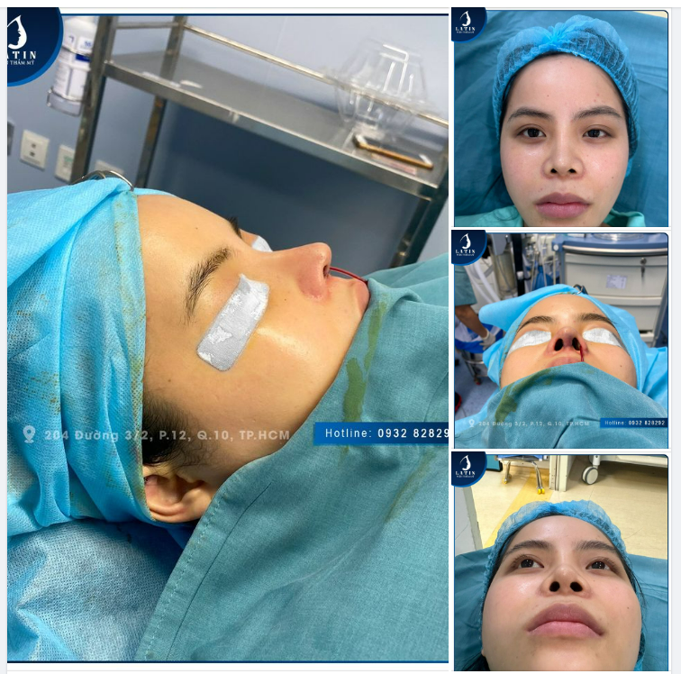 Từ Kiên Giang lên thành phố Hồ Chí Minh để sửa mũi