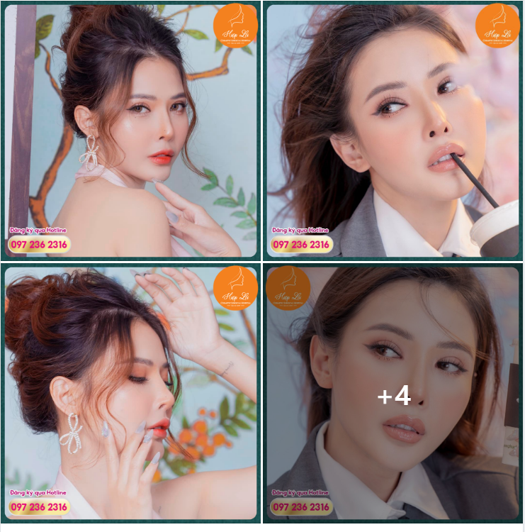 KHÔI PHỤC THÀNH CÔNG CHIẾC MŨI HỎNG - HOTGIRL 9X NGÀY CÀNG ĐẸP RẠNG RỠ