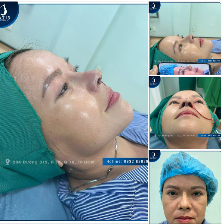 Khắc phục đầu mũi to, lộ sóng mũi do nâng mũi hỏng