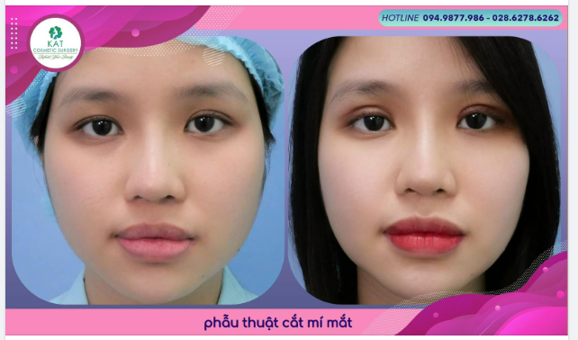 “ Giải pháp cho đôi mắt sụp mí  ᴏ̛̉ người trẻ tuổi