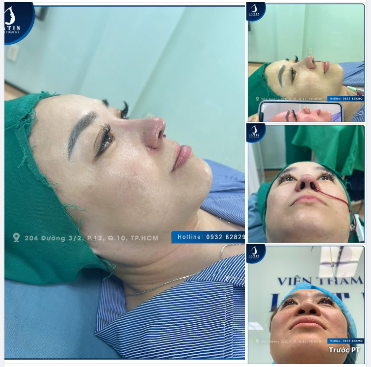 "Chỉ có gần Tết chị mới rảnh, nên chị tranh thủ thời gian đi nâng mũi luôn"