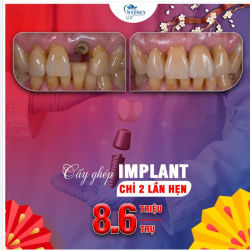 Cấy ghép Implant – Giải pháp hoàn hảo cho người mất răng