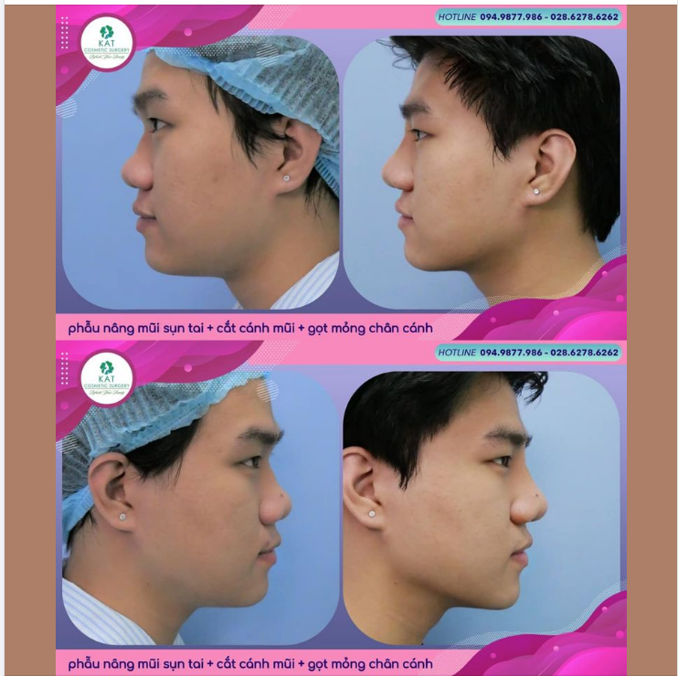 Phẫu thuật thu gọn cánh mũi nâng mũi sụn tai tại KAT là một phẫu thuật luôn được các anh chọn lựa để làm.