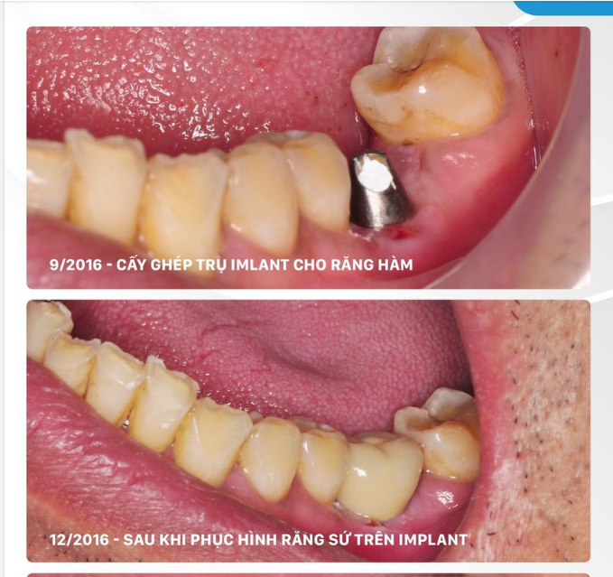 TÁI KHÁM IMPLANT SAU 6 NĂM