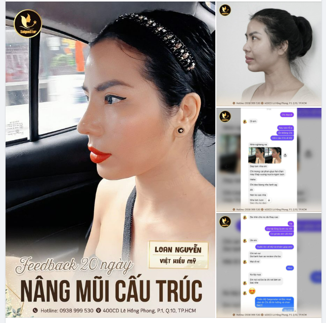FEEDBACK 20 NGÀY NÂNG MŨI CẤU TRÚC SỬA LẠI