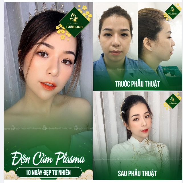 Gương mặt cân đối, đường nét hài hòa nhan sắc thêm xinh đẹp, nổi bật và cuốn hút sau Độn Cằm Vline tại Tuấn Linh!!