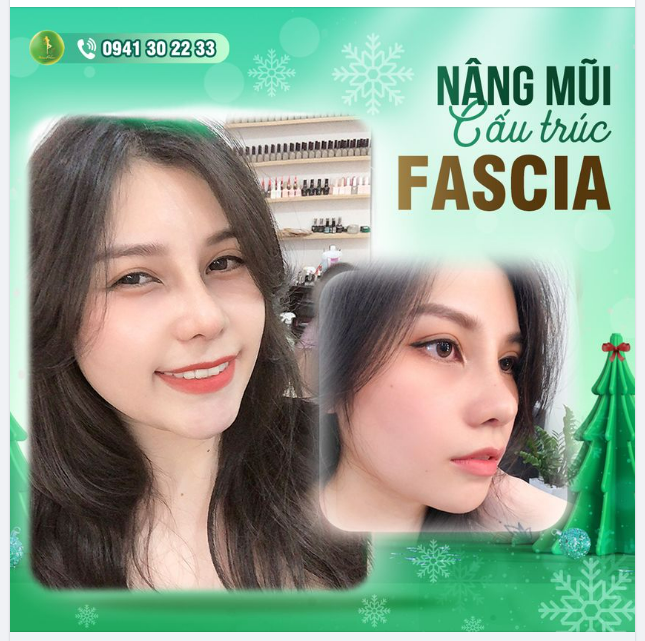 FEEDBACK KHOE DÁNG MŨI CẤU TRÚC FASCIA SAU 1 THÁNG THỰC HIỆN