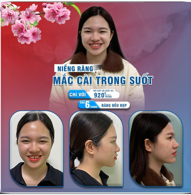 Năm mới nụ cười mới với mắc cài trong suốt