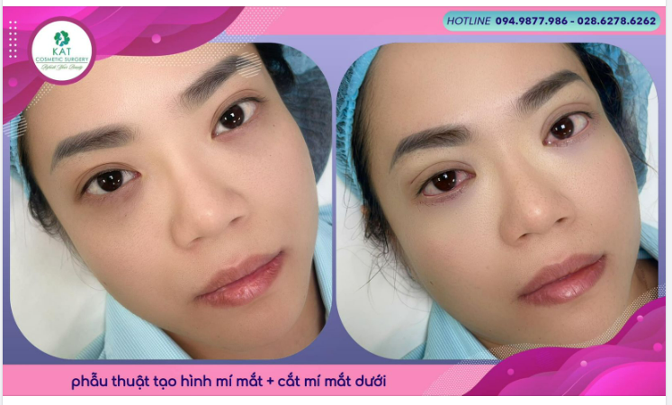 “ Combo phẫu thuật đẹp hoàn hảo dành cho người trẻ  ”