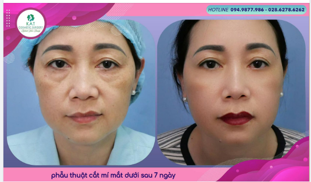 Phương pháp cắt mí mắt dưới ứng dụng cho những trường hợp cụ thể như: