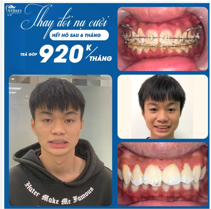 Thay đổi nụ cười với mắc cài pha lê trong suốt