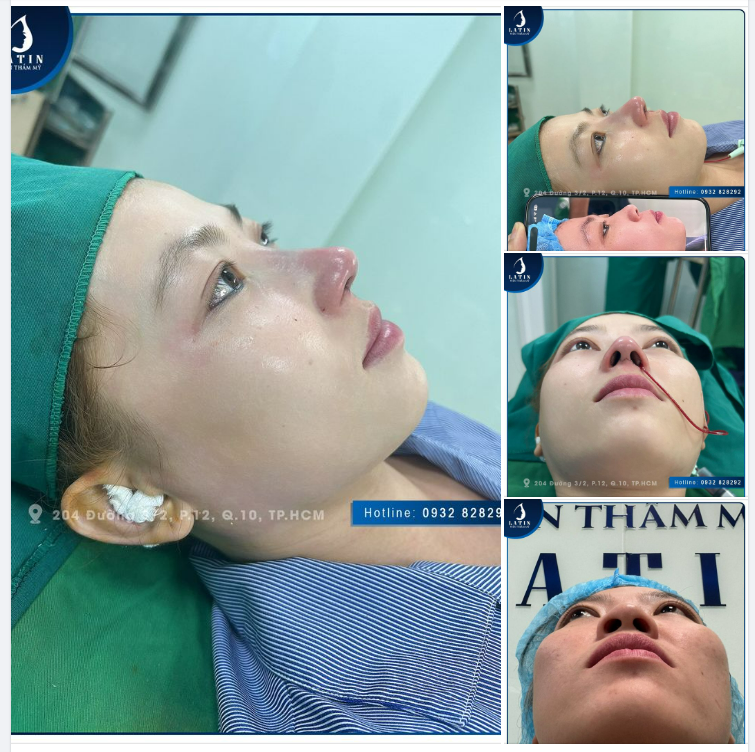 Làm đẹp đón Tết. Cận cảnh chiếc mũi nâng cấu trúc sụn tai mới làm hôm nay tại Latin