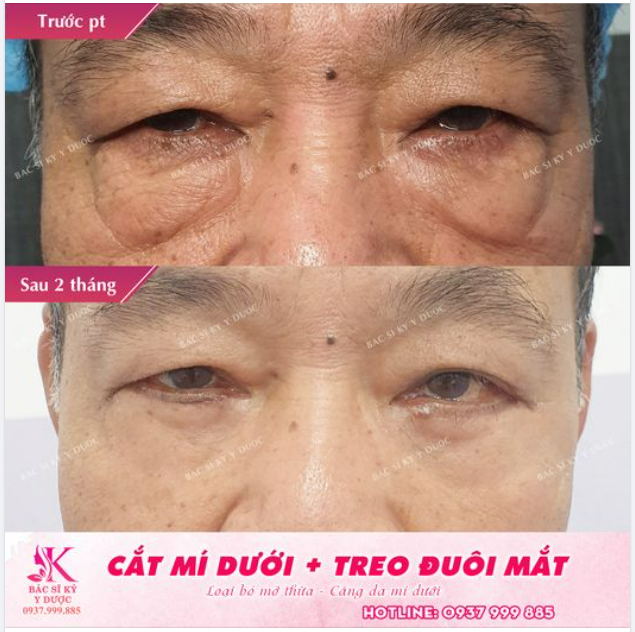 Một lần phẫu thuật CỨU cả đôi mắt