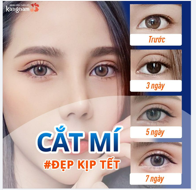 Công nghệ CẮT MÍ tốt nhất LÀNH NHANH x2 LẦN