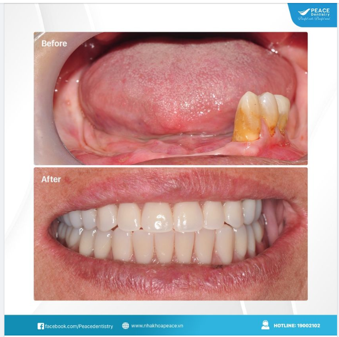 Ca lâm sàng trồng răng implant cho khách hàng Việt Kiều - Chức năng ăn nhai, thẩm mỹ được khôi phục trọn vẹn.