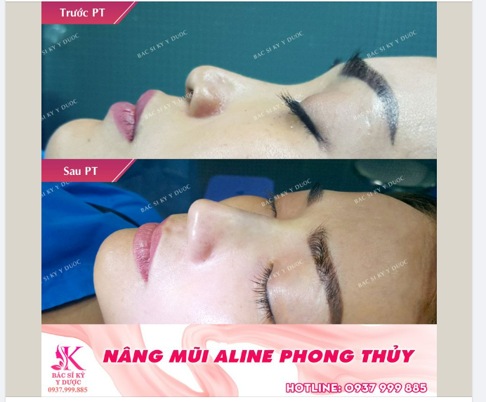 Nâng mũi thời nay đã trở thành xu hướng, ngoài tiêu chí đẹp còn phải hợp phong thủy.